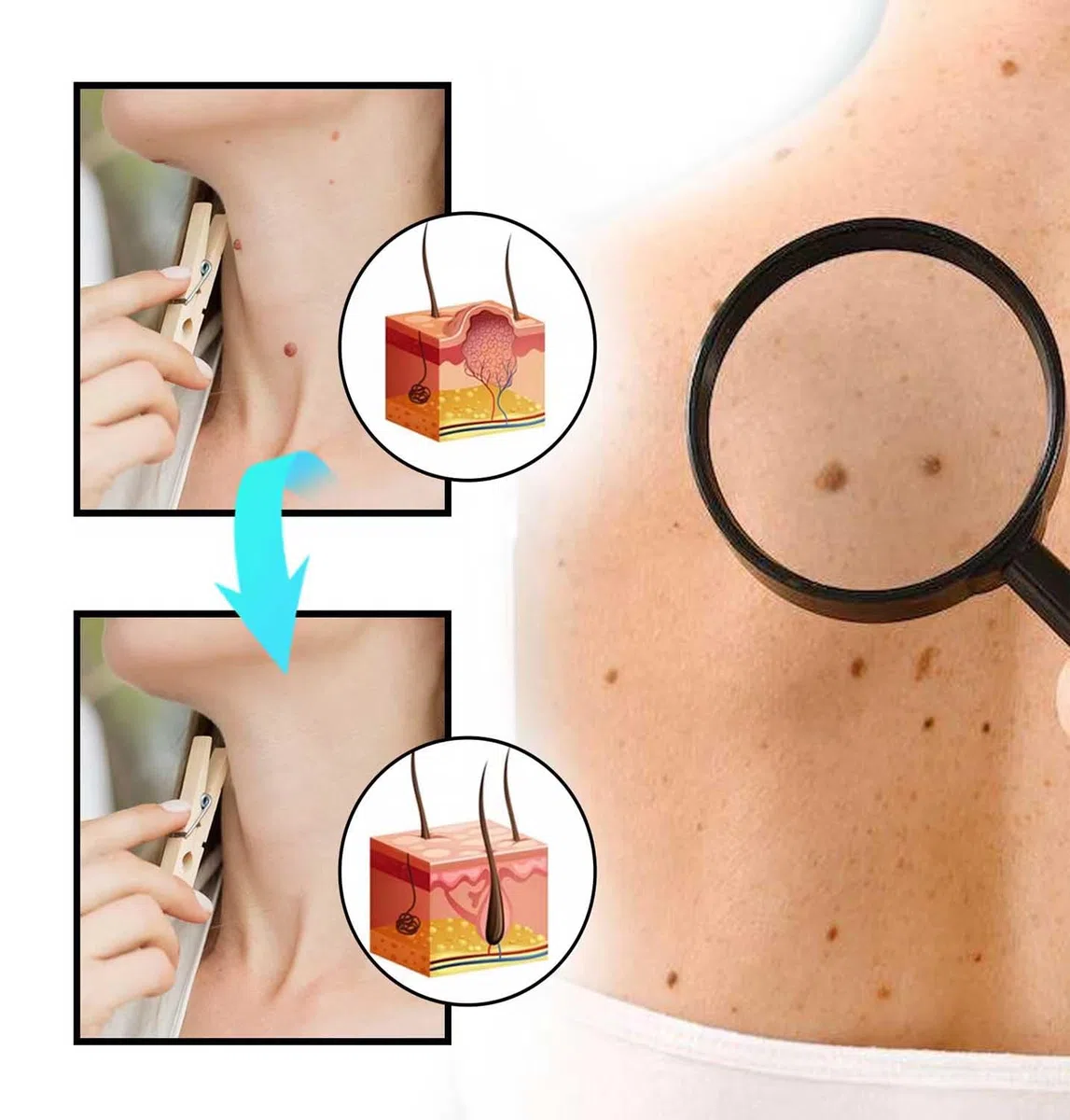 3Pcs Bee Venom Spray,Wart Removal Spray Skin Tag Removal Bee Venom Lymphatic Spray 0.67 fl.oz/20ml